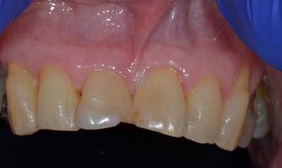 Bonding & Resin Composite Restorations case 95 — before