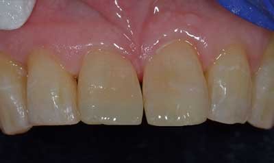 Bonding & Resin Composite Restorations case 95 — after