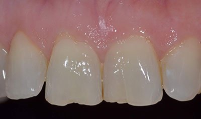 Bonding & Resin Composite Restorations case 97 — before