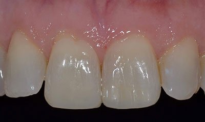 Bonding & Resin Composite Restorations case 97 — after