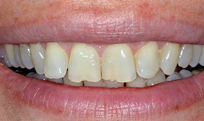 Bonding & Resin Composite Restorations case 98 — before