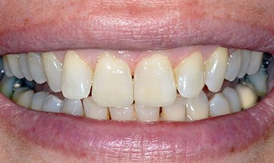 Bonding & Resin Composite Restorations case 98 — after