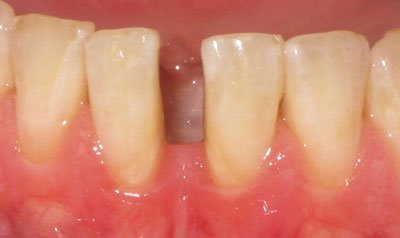 Bonding & Resin Composite Restorations case 99 — before