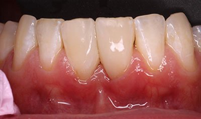 Bonding & Resin Composite Restorations case 99 — after