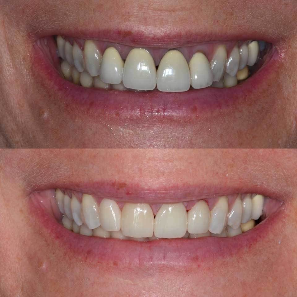 Custom Crowns and Veneers Cases case 188 — before