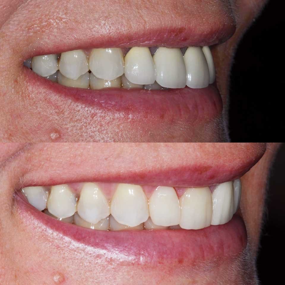 Custom Crowns and Veneers Cases case 188 — after