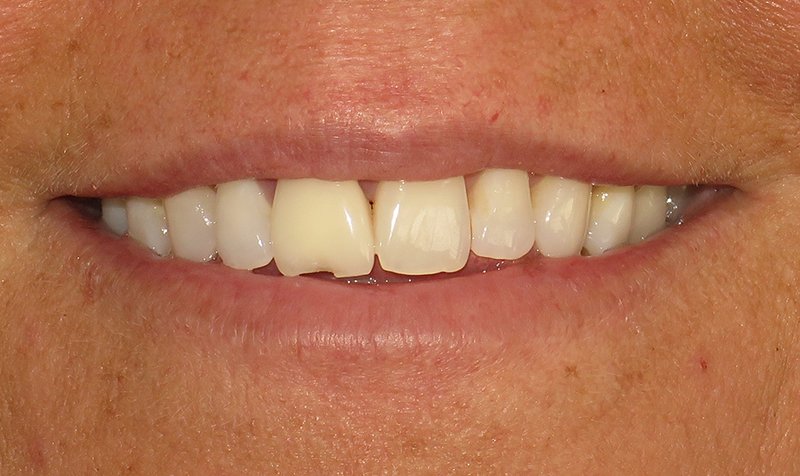 Custom Crowns and Veneers Cases case 193 — before