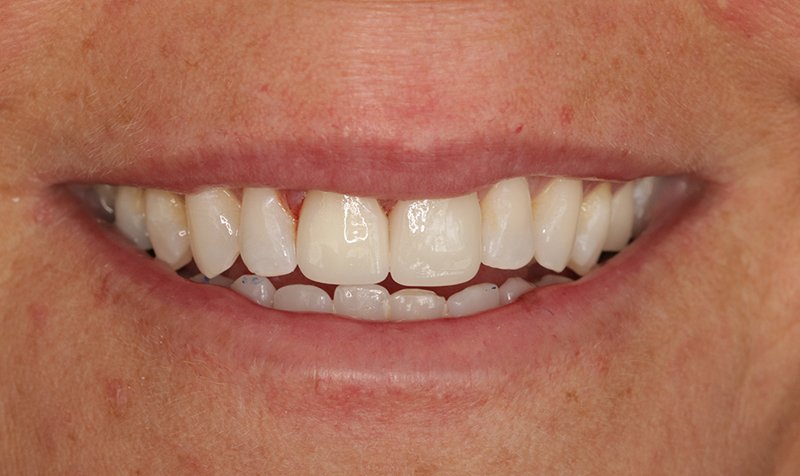 Custom Crowns and Veneers Cases case 193 — after