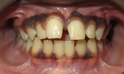 Dental Brace Cases case 3 — before