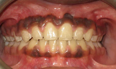 Dental Brace Cases case 3 — after