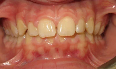 Dental Brace Cases case 4 — before