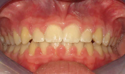 Dental Brace Cases case 4 — after