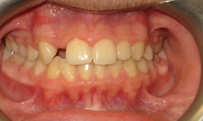 Dental Brace Cases case 5 — before