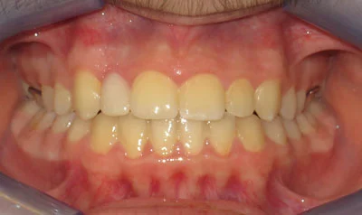Dental Brace Cases case 5 — after