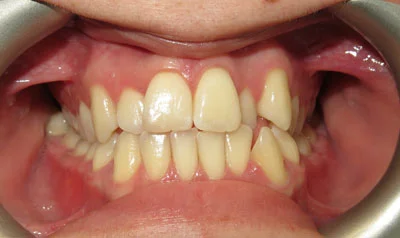 Dental Brace Cases case 6 — before