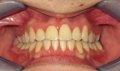 Dental Brace Cases case 6 — after