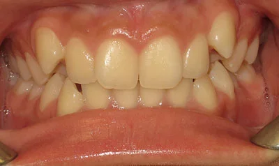 Dental Brace Cases case 115 — before