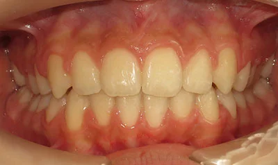 Dental Brace Cases case 115 — after