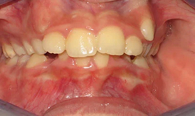 Dental Brace Cases case 116 — before
