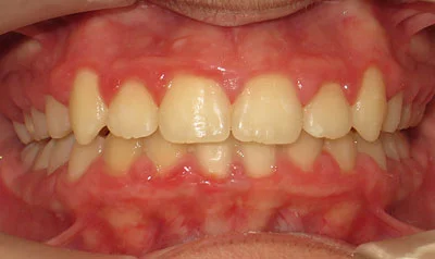 Dental Brace Cases case 116 — after