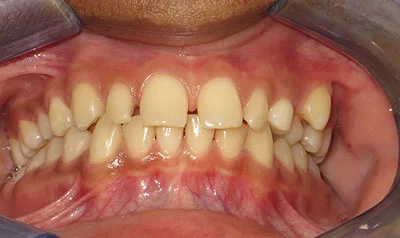 Dental Brace Cases case 117 — before