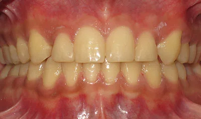 Dental Brace Cases case 117 — after