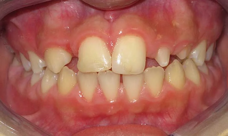 Dental Brace Cases case 124 — before