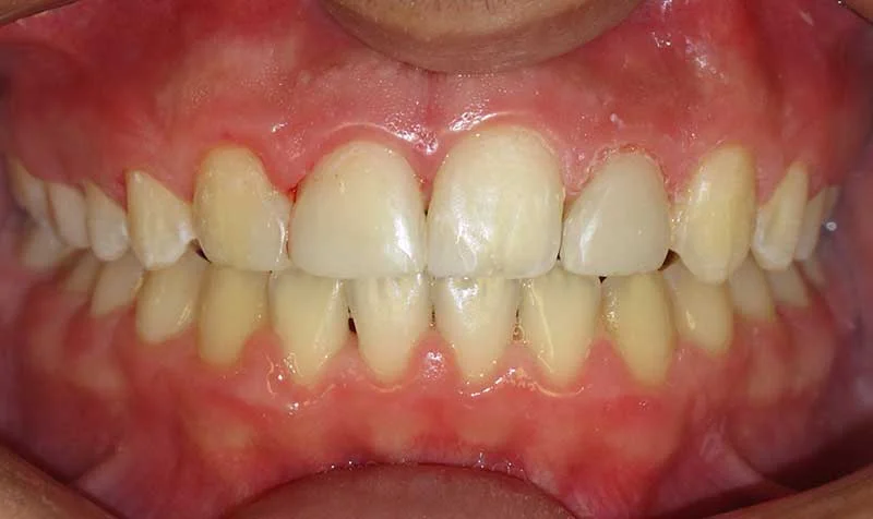 Dental Brace Cases case 124 — after