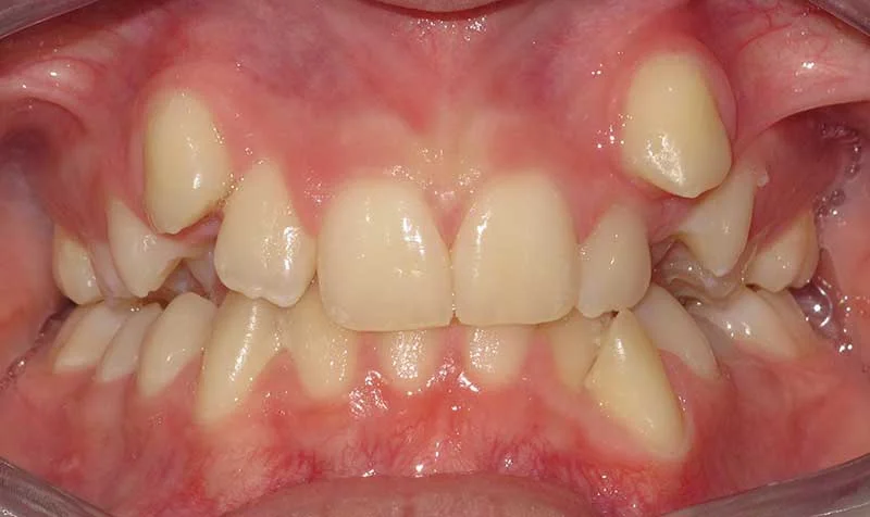 Dental Brace Cases case 125 — before