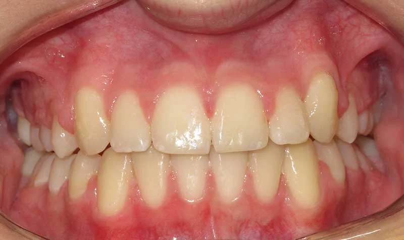 Dental Brace Cases case 125 — after