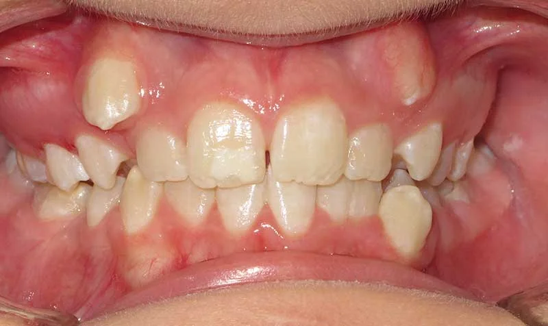 Dental Brace Cases case 126 — before