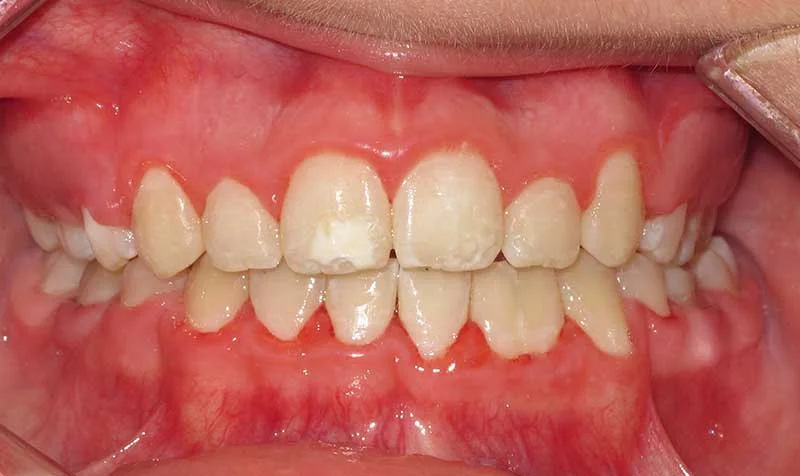Dental Brace Cases case 126 — after