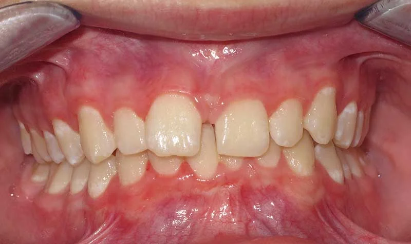 Dental Brace Cases case 127 — before