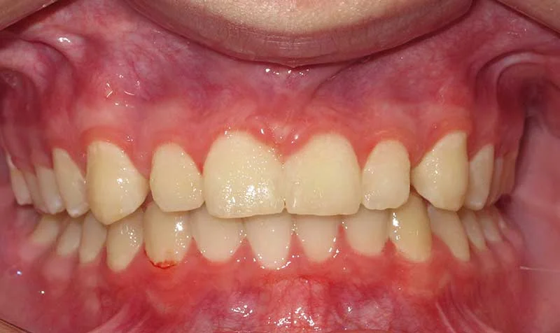 Dental Brace Cases case 127 — after