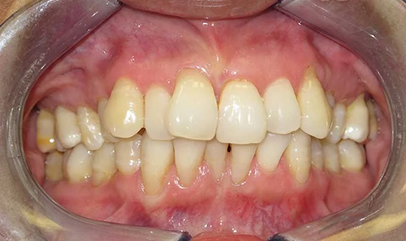 Dental Brace Cases case 128 — before