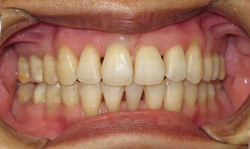 Dental Brace Cases case 128 — after