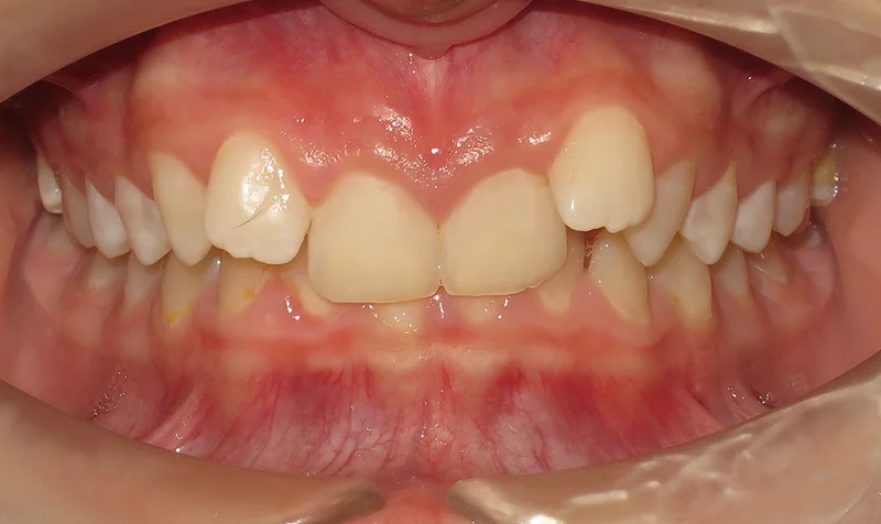 Dental Brace Cases case 191 — before