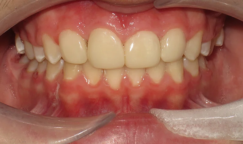 Dental Brace Cases case 191 — after