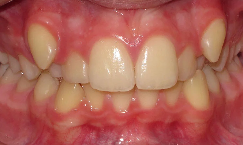 Dental Brace Cases case 206 — before