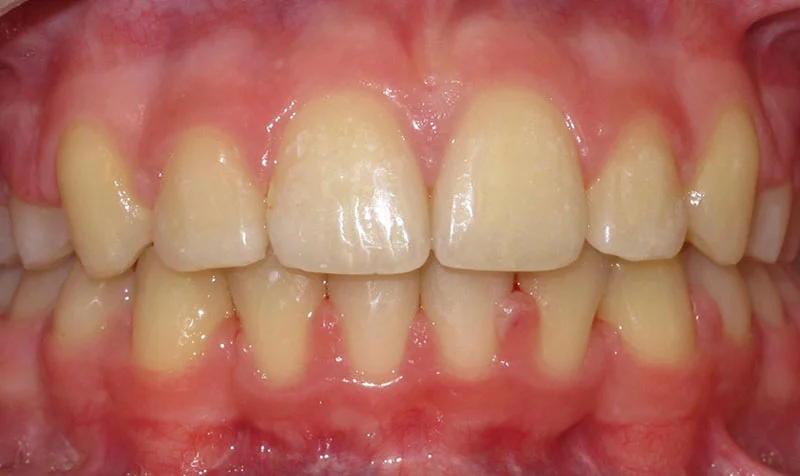 Dental Brace Cases case 206 — after