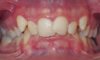 Dental Brace Cases case 48 — before