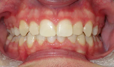 Dental Brace Cases case 48 — after