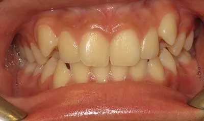 Dental Brace Cases case 91 — before