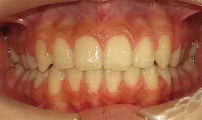 Dental Brace Cases case 91 — after
