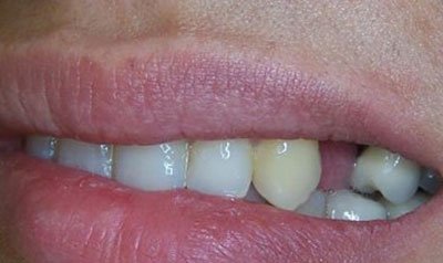Dental Implant Cases case 10 — before