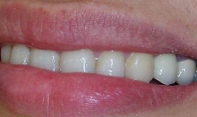 Dental Implant Cases case 10 — after