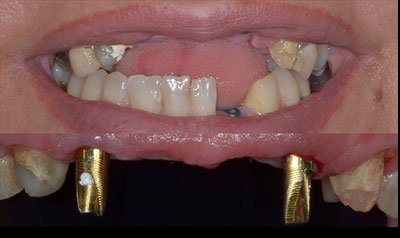 Dental Implant Cases case 102 — before