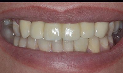 Dental Implant Cases case 102 — after
