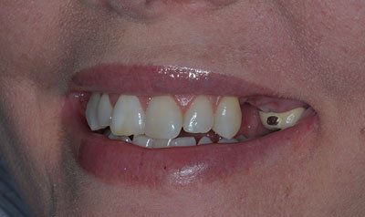 Dental Implant Cases case 106 — before