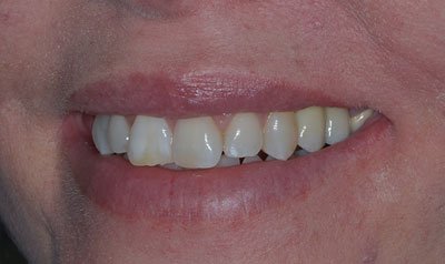 Dental Implant Cases case 106 — after